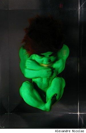 Fetal Hulk